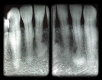 Periapical Cemental Dysplasia2.jpg